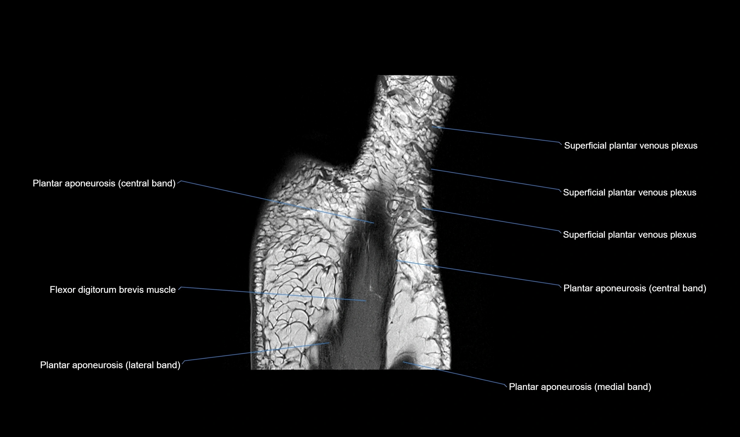 MRI mid foot coronal ligaments cross sectional anatomy 3T  radiology  image-img-00001-00039.webp